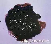 吃瓜尔胶 黑便,揭秘吃瓜尔胶引发黑便的奥秘